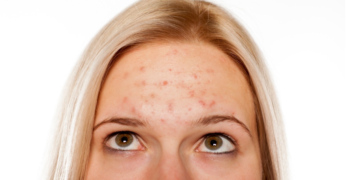 woman with pimples on her forehead