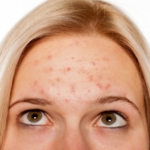 woman with pimples on her forehead